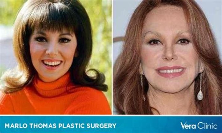 Marlo Thomas Face Plastic Surgery: Does She Have Any Children With Her Husband?